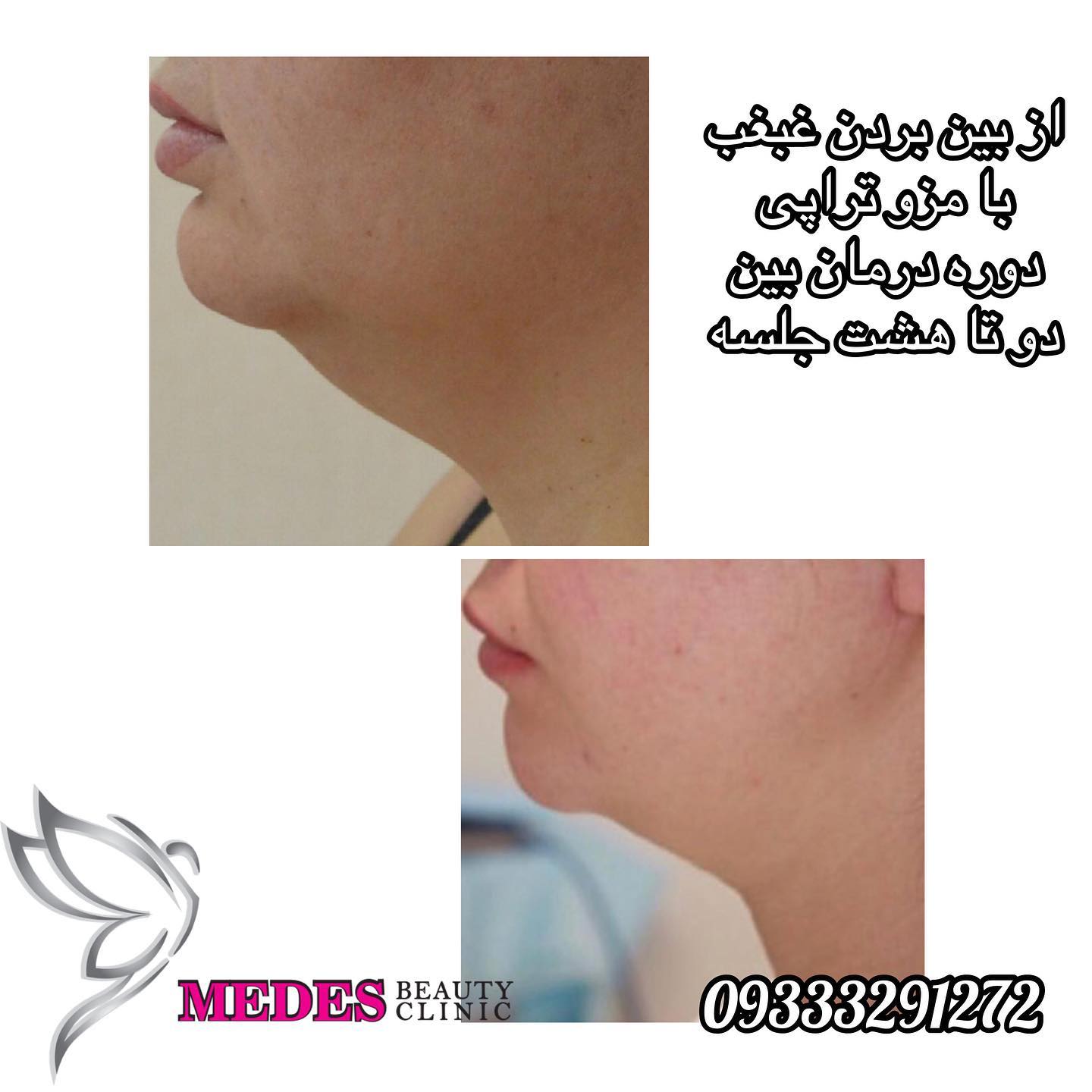 گالری مزوتراپی